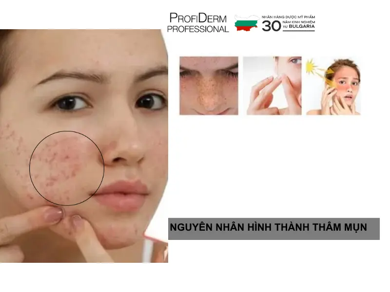 phục hồi da thâm mụn