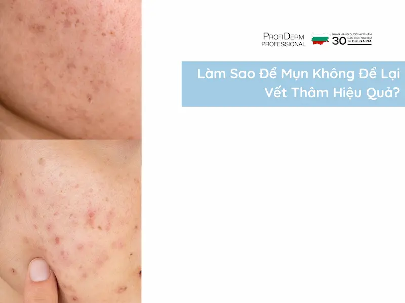 làm sao để mụn không để lại vết thâm