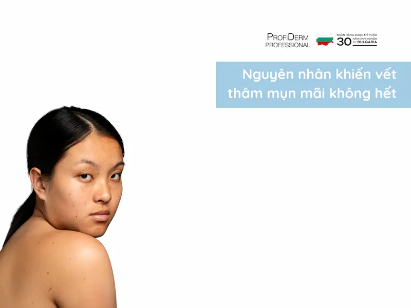vết thâm mụn mãi không hết