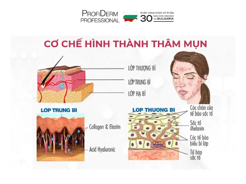 phục hồi da thâm mụn