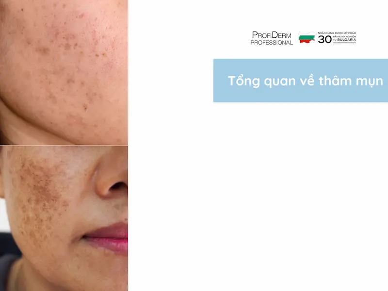 kem chống nắng trị thâm