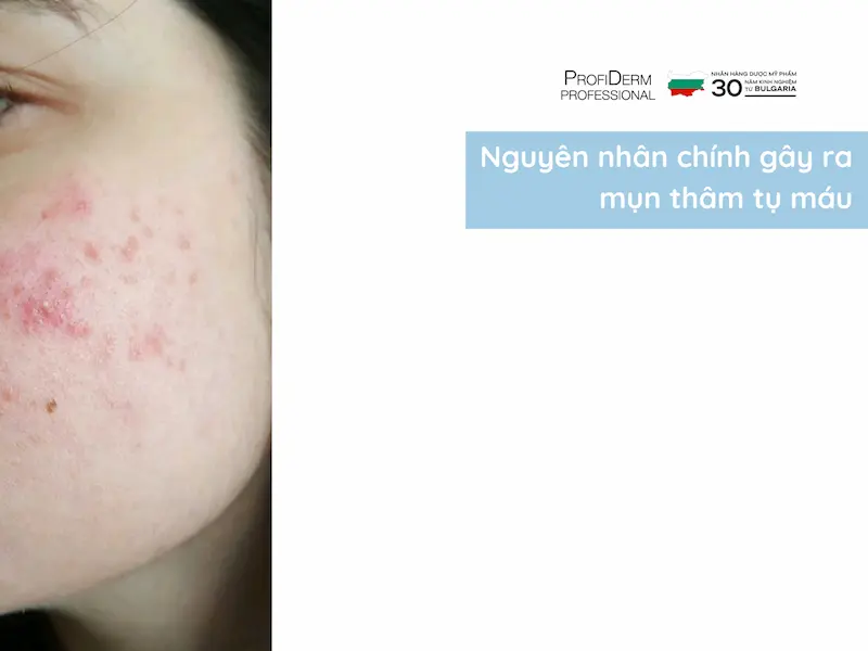 mụn thâm tụ máu có tự hết không