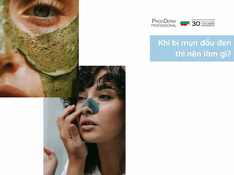 Khi bị mụn đầu đen thì nên làm gì?