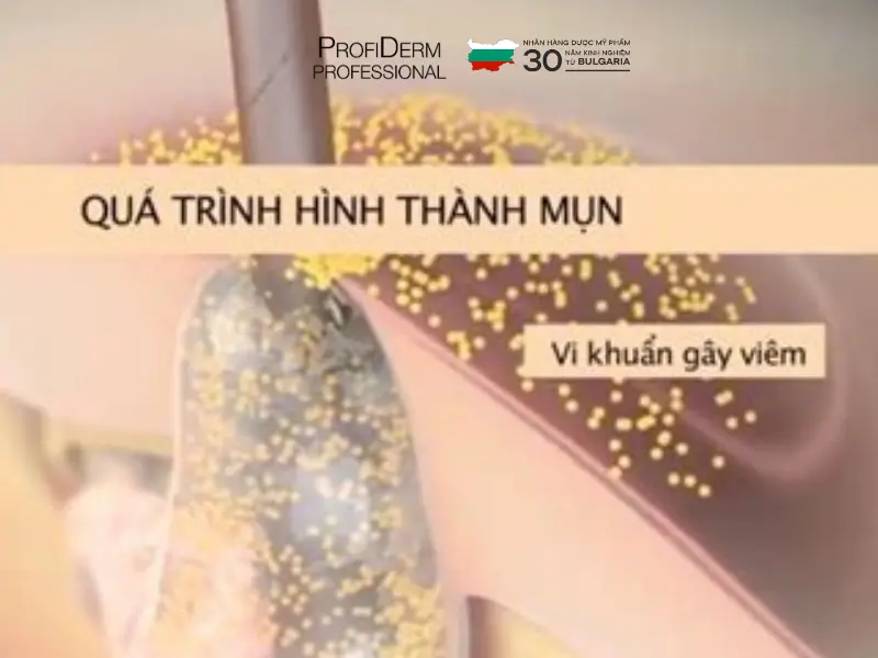 các loại thâm mụn