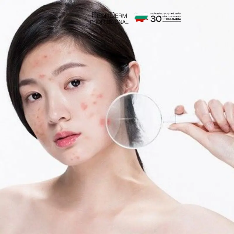 skincare mà vẫn bị mụn
