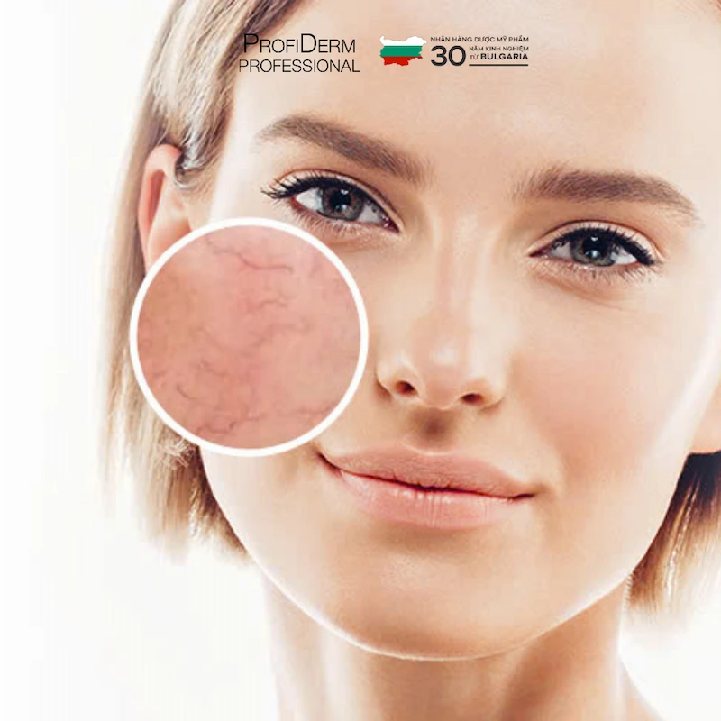 phục hồi da bị giãn mao mạch