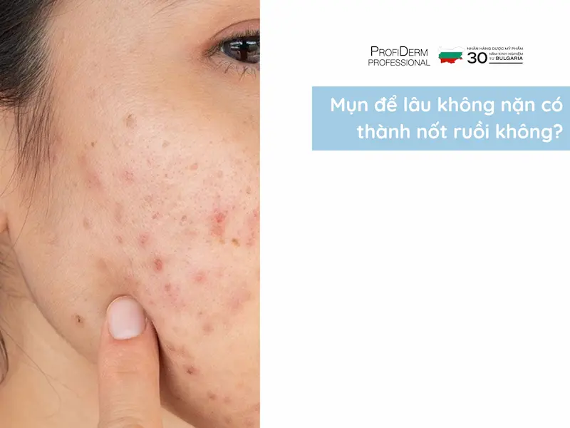 mụn để lâu không nặn có thành nốt ruồi không