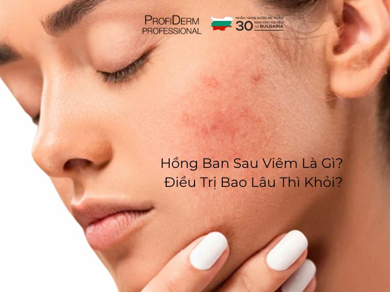 #Hồng Ban Sau Viêm Là Gì? Điều Trị Bao Lâu Thì Khỏi?