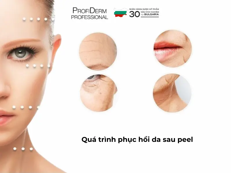 phục hồi da sau peel