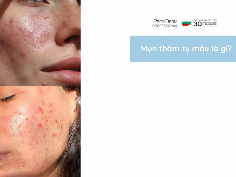 mụn thâm tụ máu