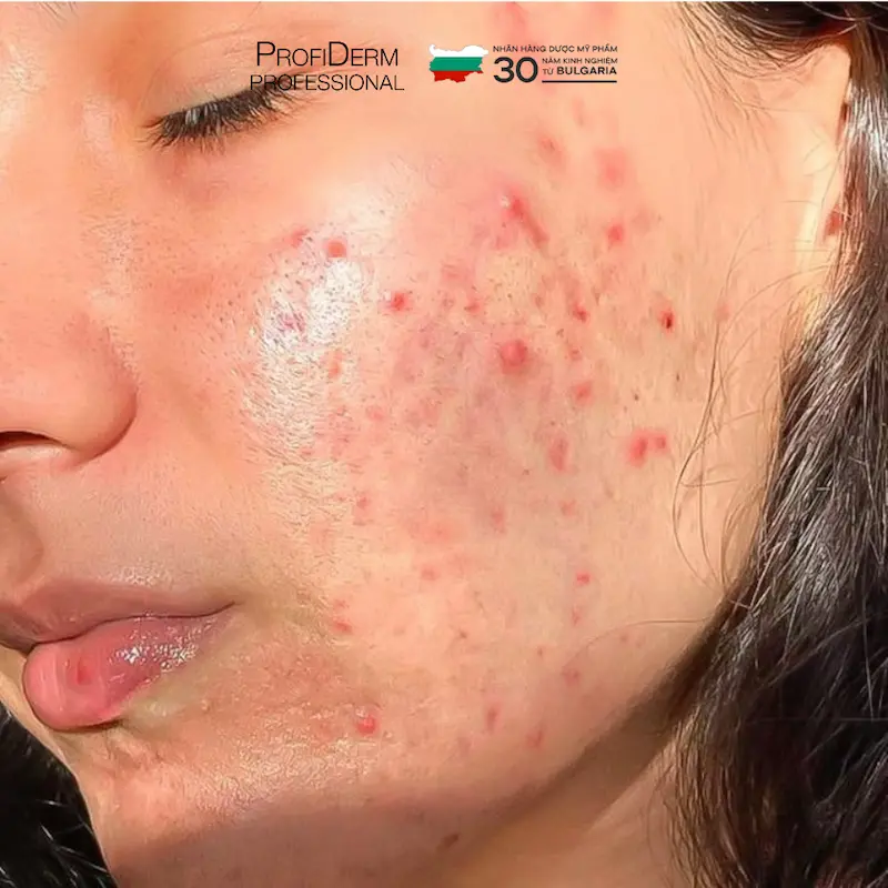cách phục hồi da bị dị ứng mỹ phẩm