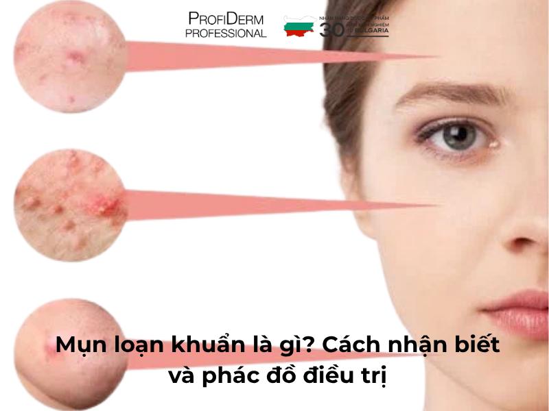 Mụn Loạn Khuẩn Là Gì? Cách Nhận Biết Và Phác Đồ Điều Trị