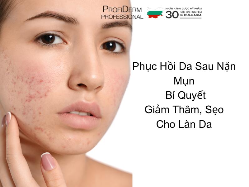 Phục Hồi Da Sau Nặn Mụn: Bí Quyết Giảm Thâm, Sẹo Cho Làn Da