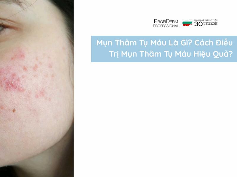 Mụn thâm tụ máu là gì? Cách điều trị mụn thâm tụ máu hiệu quả?