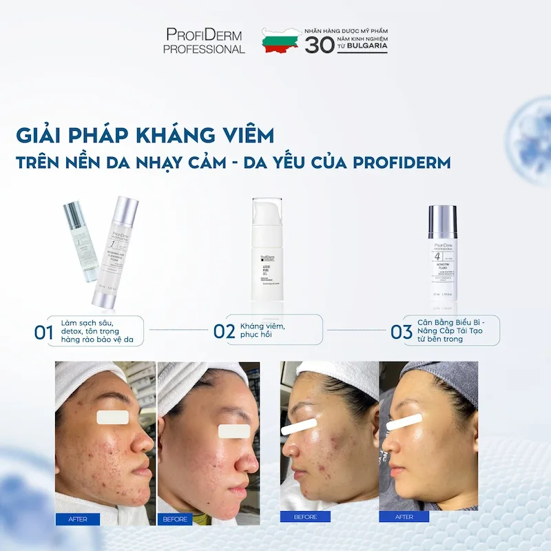 Lợi ích khi lựa chọn sữa rửa mặt Profiderm Lợi ích khi lựa chọn sữa rửa mặt Profiderm