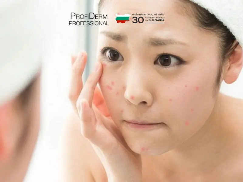 cách phục hồi da bị dị ứng mỹ phẩm