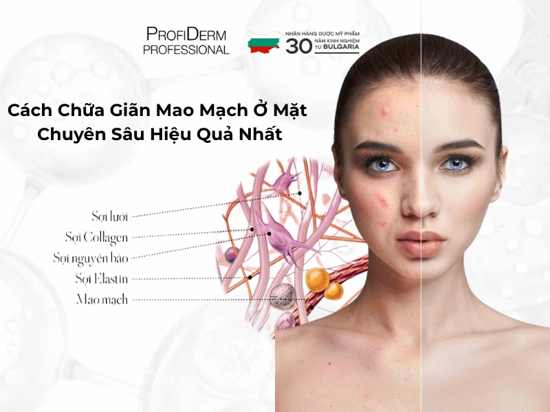 cách chữa giãn mao mạch ở mặt