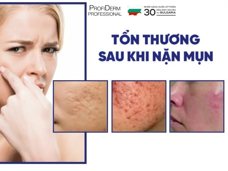 phục hồi da sau nặn mụn