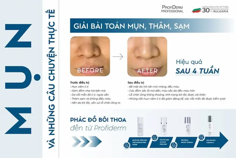 Khách hàng Profiderm điều trị PIE